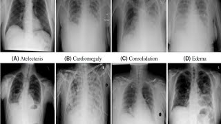 Chest Xray Pathology  Radiology  Education 123radiology 123radiology Radiologando [upl. by Narmi]