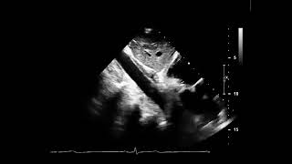 Echocardiography SC long axis abdominal aorta [upl. by Tham671]