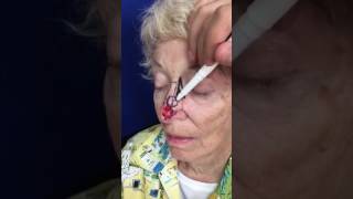 Designing Bilobe Flap for Nose Reconstruction [upl. by Eiluj418]