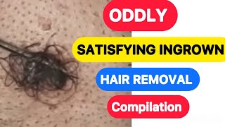 Satisfying Ingrown Hair Compilation Video  Oddly Satisfying ingrown Hair [upl. by Ahsrats]