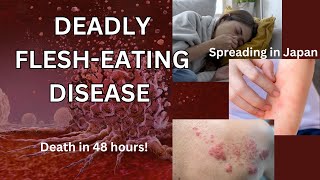 Deadly FleshEating Disease  STSS  News  What you need to know [upl. by Aliahkim376]