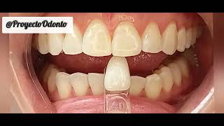 Aclaramiento dental  Blanqueamiento Dental ProyectoOdonto jairaruba jairaruba [upl. by Dahle]