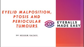 Eyelid malposition ptosis and periocular tumours [upl. by Abehsile267]