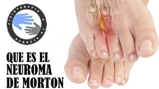 Neuroma de Morton que es y como se produce [upl. by Frederick]