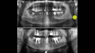 Zahnärzte Zahnsanierung Parodontitis und Implantate [upl. by Nirtak]