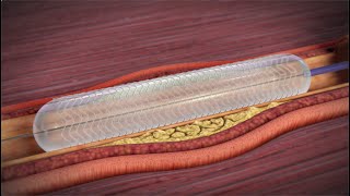 What is a Coronary Angioplasty [upl. by Campy]