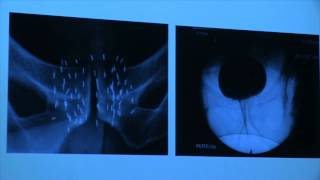 Symposium urologie prostaatkanker 6 december 2014  Dr Elke Blyweert [upl. by Haddad]