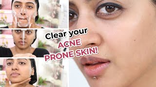 Salicylic Acid Acne Prone Skin Care Routine [upl. by Mahoney72]