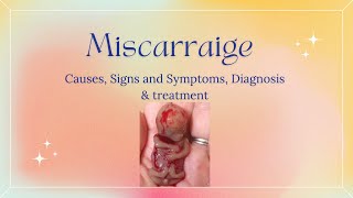 MISCARRIAGE Causes Signs and Symptoms Diagnosis and Treatment [upl. by Lennahc]