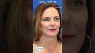 Look 20 Years Younger GORGEOUS Facelift Transformation [upl. by Rosinski]