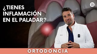 ¿Tienes INFLAMACIÓN en el PALADAR superior [upl. by Alliber]