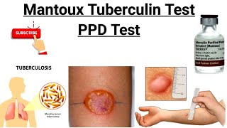 Mantoux Test  Tuberculin Skin Test  PPD Test  Purified protein derivative [upl. by Eliades]