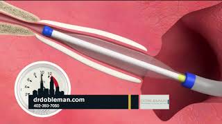 Eustachian Tube Dysfunction Balloon Treatment [upl. by Fawcett680]