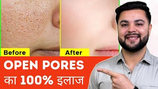 Open Pores Clogged Pores amp Blackheads का 100 इलाज [upl. by Orna675]