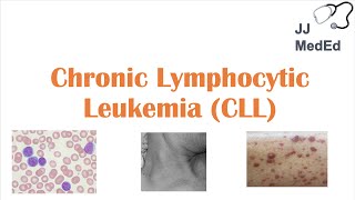 Chronic Lymphocytic Leukemia CLL Symptoms ex Skin Blisters Diagnosis and Treatment Vit D [upl. by Wadsworth716]