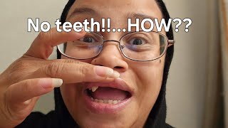 Life update  How I knocked my teeth out  storytime [upl. by Dnomhcir321]