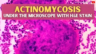 Actinomycosis under the microscope with Haematoxylin and Eosin HampE stain [upl. by Nwahsram844]