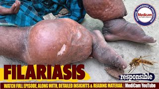 🦟Filariasis Lymphatic Filariasis Causes Symptoms and Treatment Options [upl. by Ardnassela]