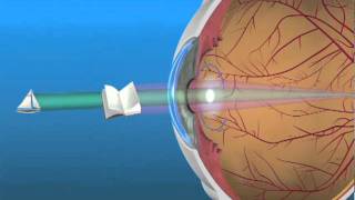 Multifocal Lens IOL [upl. by Nirret]