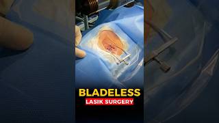 Bladeless LASIK Procedure [upl. by Oecile]