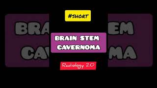 MRI BRAIN 🧠 BRAIN STEM CAVERNOMA  SHORT [upl. by Ynamad]