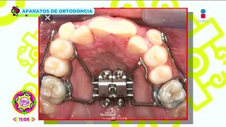 Aparatos de ortodoncia Máscara de Protracción hyrax retenedores dentales y más  Sale el Sol [upl. by Alor]