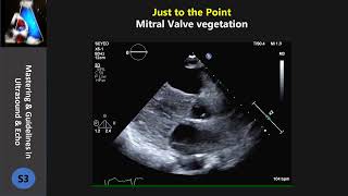 Mitral Valve vegetation [upl. by Budd]