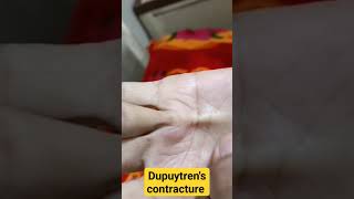 Dupuytrens contracture in chronic liver disease patientidentifydiagnosisliverdisease [upl. by Nostrebor]