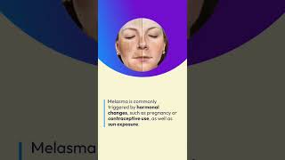 What are these SPOTS on my FACE Learn about MELASMA 1million viral skincare melasma shorts [upl. by Itsrik]