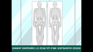 Comment comprendre les résultats dune scintigraphie osseuse [upl. by Hy]