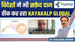 जो विदेशों में नहीं हुआ वह कर रहा है Kayakalp Global  Best Vitiligo Treatment Results [upl. by Eellac99]