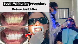 Teeth Scaling Polishing and Whitening Procedure Step By Step  Female Dentist in Lahore [upl. by Augustin]