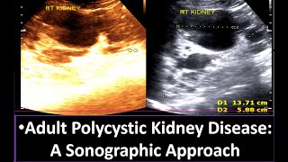 Understanding Adult Polycystic Kidney Disease A Sonographic Approach  Polycystic Kidney Disease [upl. by Joo487]