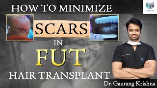 Why Patients are moving away from FUT FUT Hair Transplant Before amp After MedLinks Hair Transplants [upl. by Hernandez]