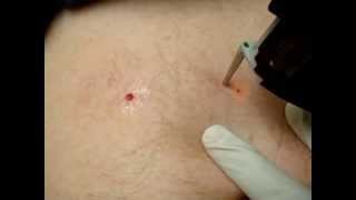 Cherry Angiomas Red Moles Treatment [upl. by Chapman]