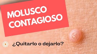 MOLUSCO CONTAGIOSO  Lo que necesitas saber para decidir [upl. by Ainessej650]