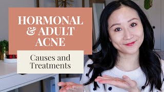 Treating Hormonal Acne  Dermatologist Tips [upl. by Scrivenor358]