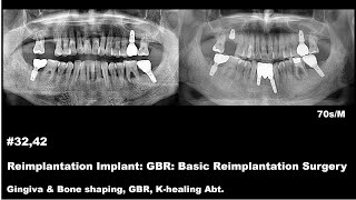 32 Reimplantation Implant GBR Basic Reimplantation Surgery [upl. by Nnaid703]