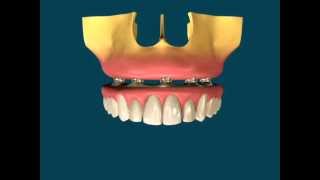 Protocolo sobre Implantes Dentários [upl. by Nylanej]