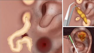 ASMR Ear Infection piercing pus  Removel Earrings Clean Animation process  Ear Treatment asmr [upl. by Enia574]