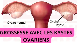 Tomber enceinte avec les kystes ovariens est possible  je t’explique tout [upl. by Rockwood]