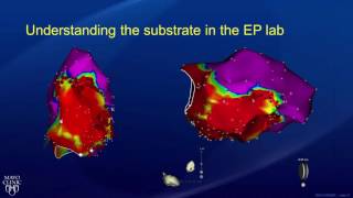 Ablation Treatment for Ventricular Tachycardia  Part 2 [upl. by Rovert]