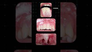 வாயில் ஏற்படும் பூஞ்சை தொற்று Oral Thrush Dr Isacc Abbas [upl. by Aicilaana]