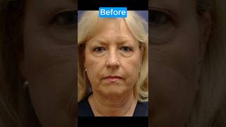 BROWLIFT TRANSFORMATION blepharoplasty [upl. by Ikram160]