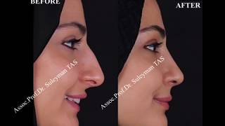 Closed amp Atraumatic Technique  Rhinoplasty [upl. by Romona]