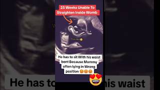 wrong baby position 25 weeks due to mothers position🥲🥲🥲viralvideo trending baby [upl. by Isman]