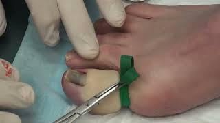 BIG Toenail  Partial Removal [upl. by Jarv]