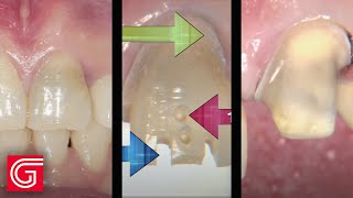 HOW TO Prepare Anterior Teeth Using a Reverse Preparation Technique [upl. by Ellenehs391]