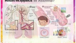 Asthma inhaler and spacer usePart 1 [upl. by Aeikan]