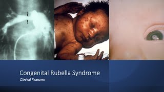 Congenital Rubella Syndrome Early and Late Onset Manifestations [upl. by Lietman]